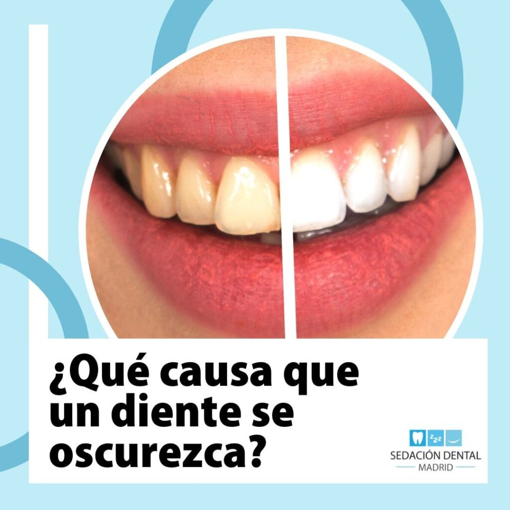 ¿Qué causa que un diente se oscurezca? 

Los dientes oscurecidos son una variaci...