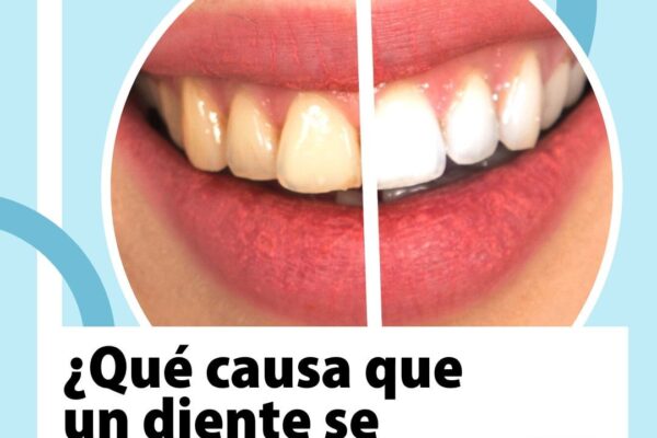 ¿Qué causa que un diente se oscurezca? 

Los dientes oscurecidos son una variaci...